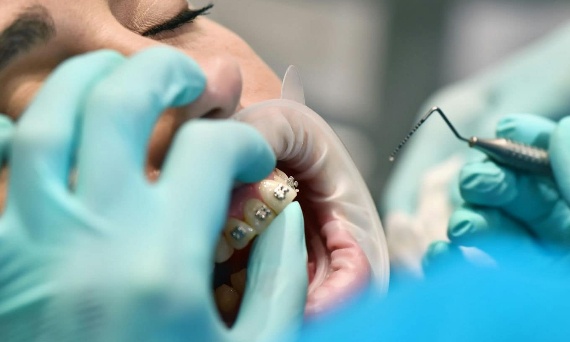 Zakładanie aparatu ortodontycznego - przegląd potrzebnych narzędzi